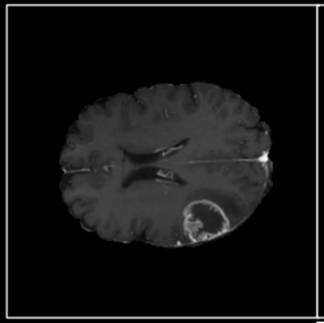 IDH mutation prediction model visualization